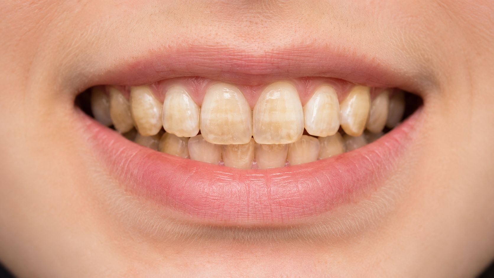 A close-up view of a person's smile showing significant yellowing and discoloration on their natural teeth.