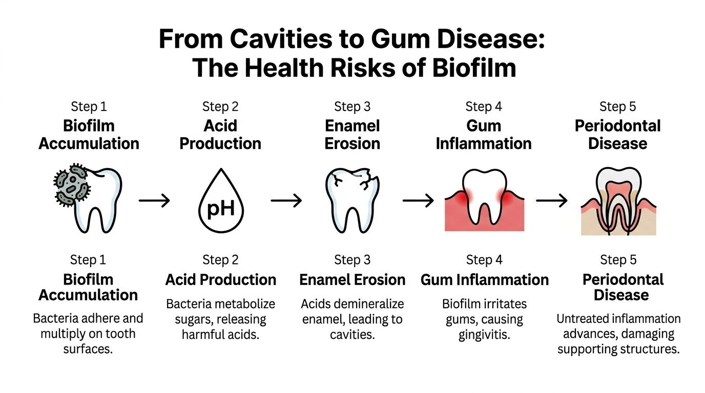 An infographic showing the five-step progression from bacterial biofilm accumulation to advanced periodontal disease on teeth.