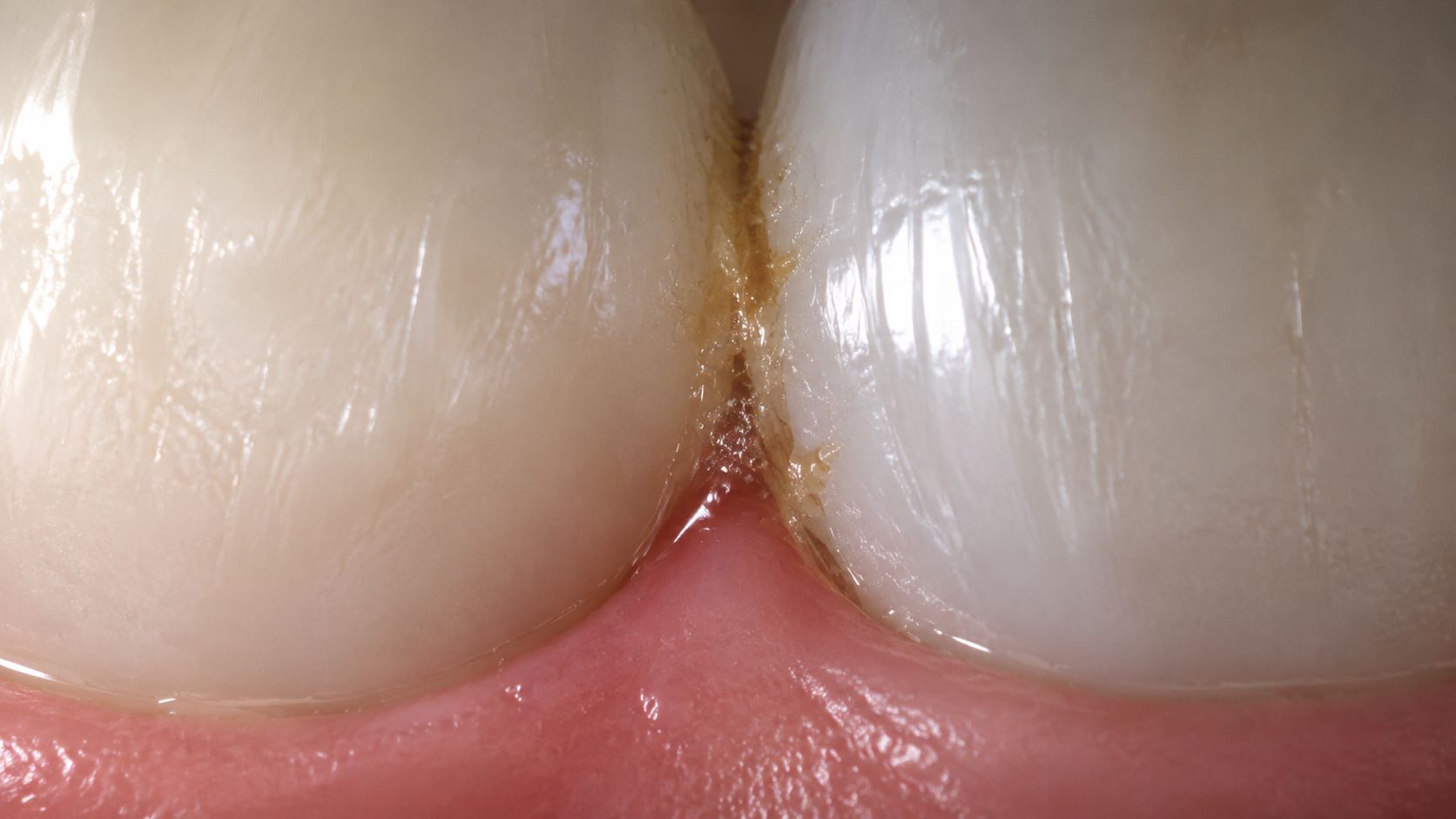 Close-up view of two human teeth showing plaque buildup and staining in the space between them.