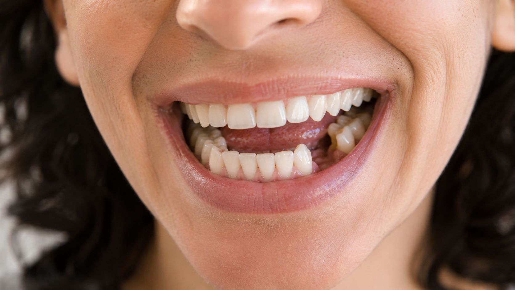 A close-up view of a person smiling, showcasing missing teeth in their lower dental arch.