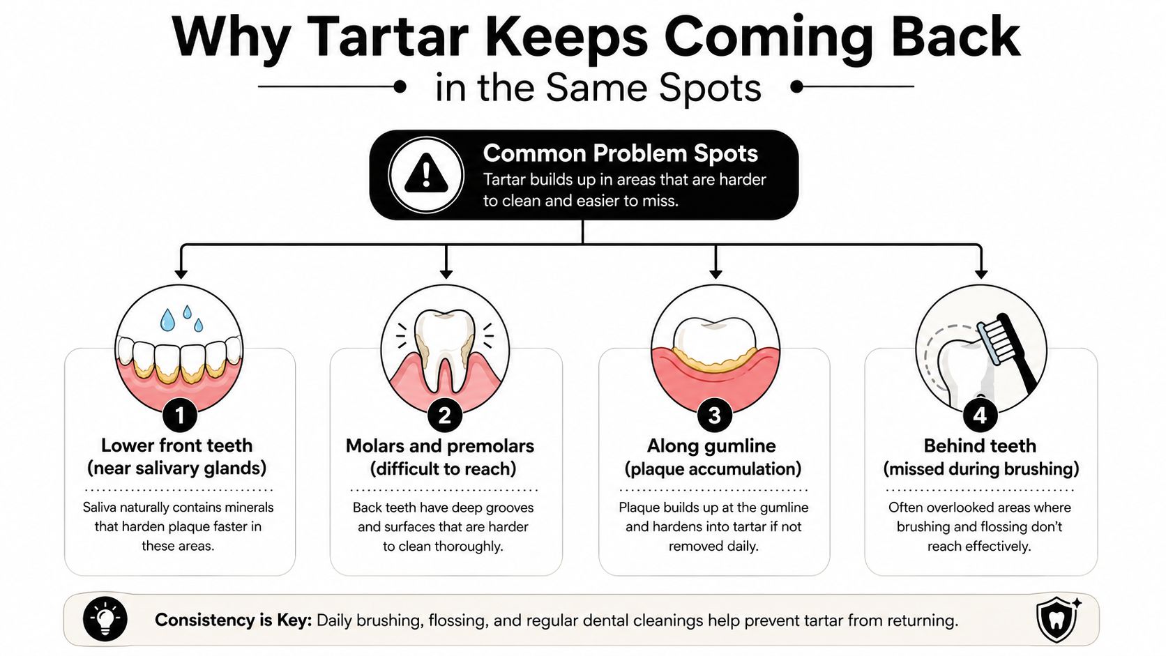 An infographic showing the common areas where tartar builds up on teeth, including lower front teeth and molars.