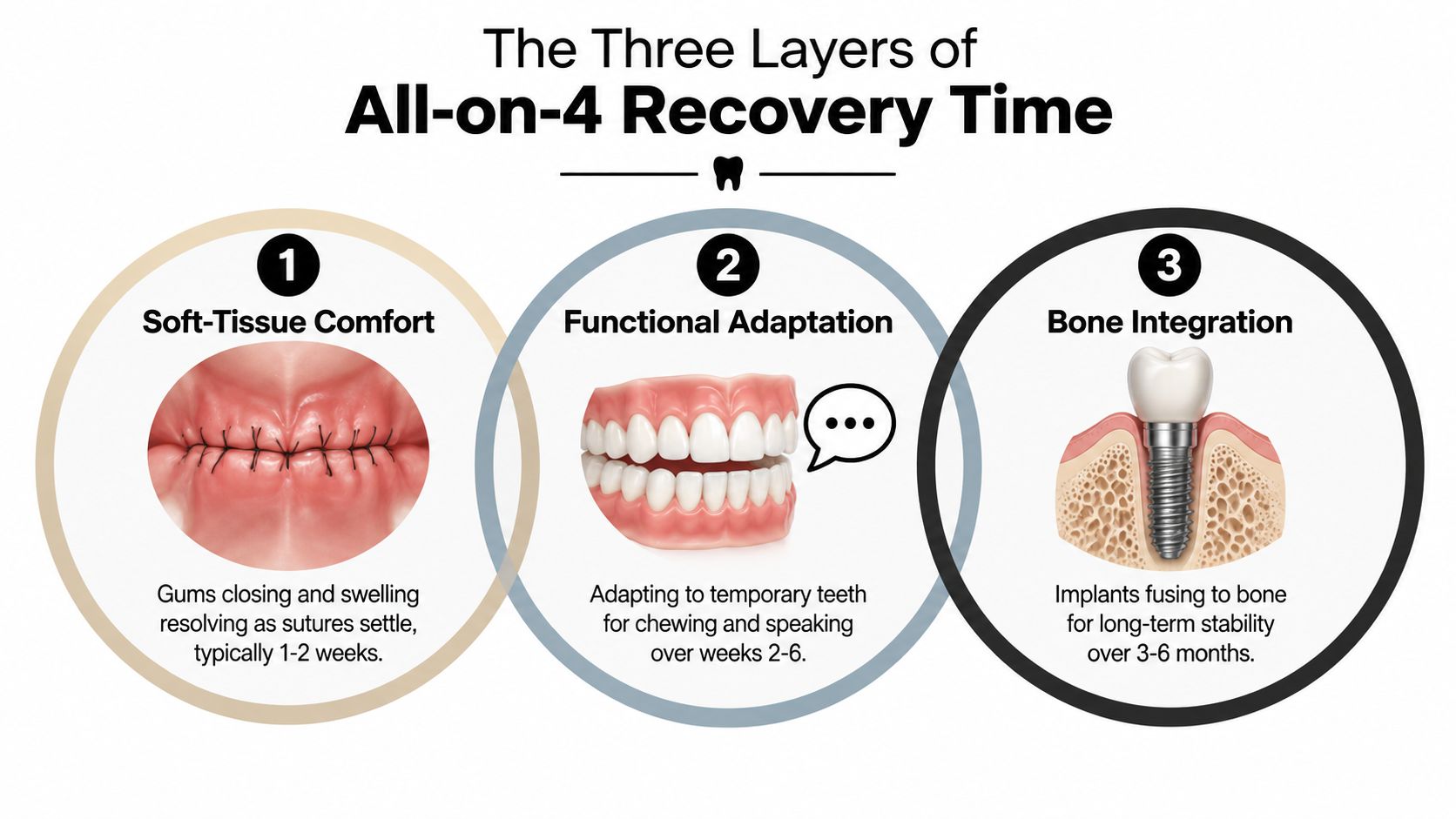 An infographic detailing the three distinct stages and recovery timelines for All-on-4 dental implant procedures.