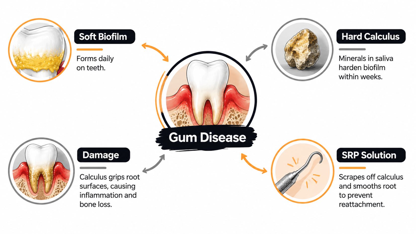 A diagram illustrating the progression of gum disease from soft biofilm buildup to hard calculus and tooth damage.
