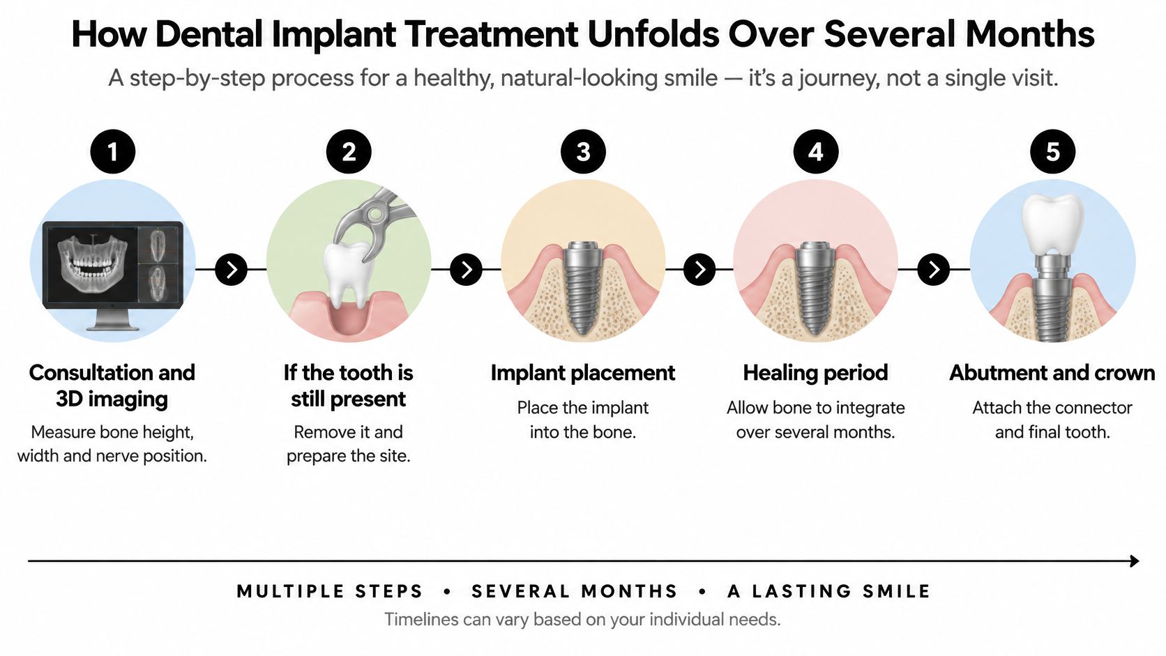 A five-step infographic showing the stages of dental implant surgery from consultation to final crown placement.