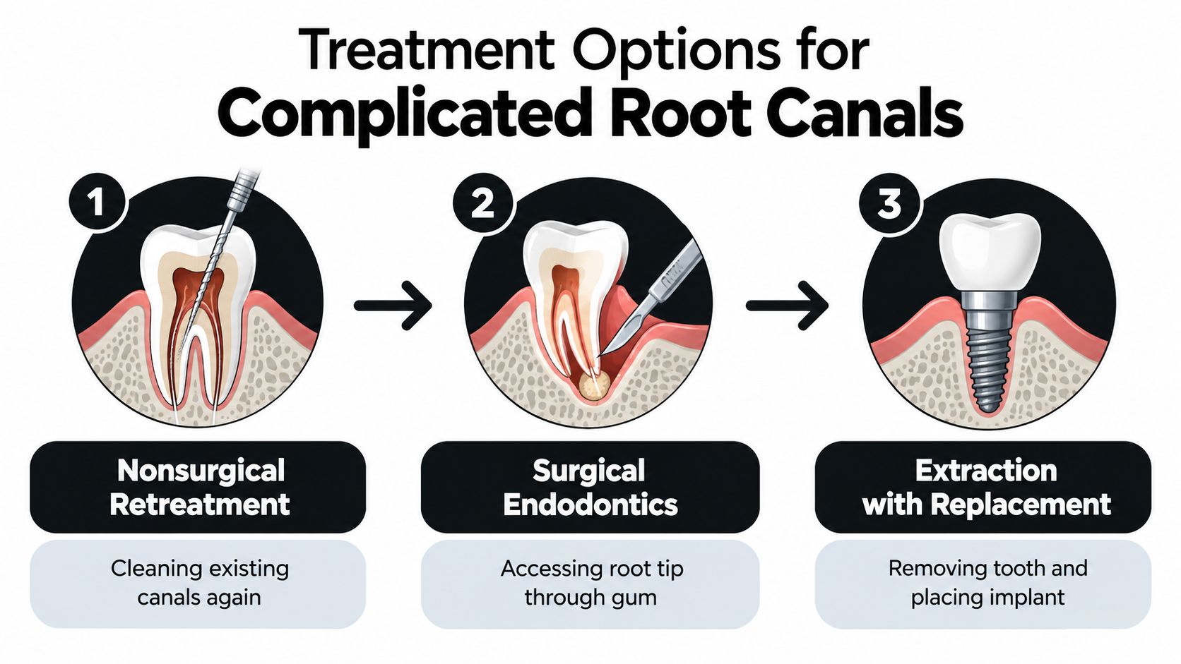 An infographic showing three dental treatment options for complicated root canals: nonsurgical retreatment, surgical endodontics, and tooth extraction.